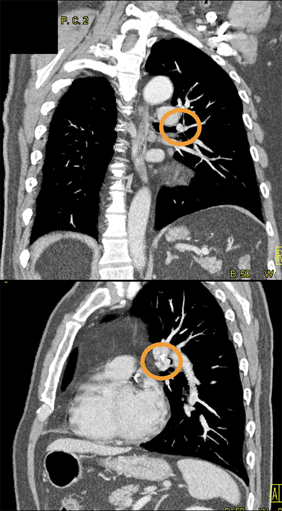 Carcinoid  Tumor Airway