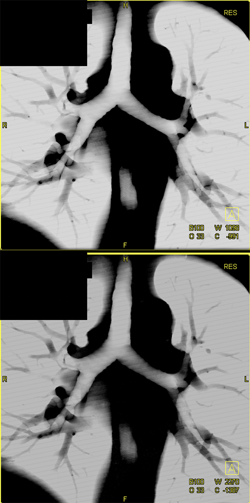 CT of the Trachea