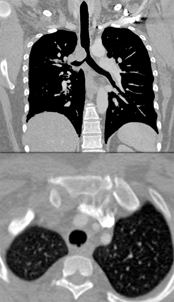 CT of the Trachea