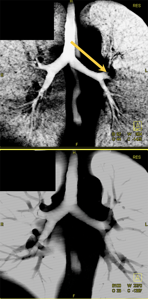 CT of the Trachea