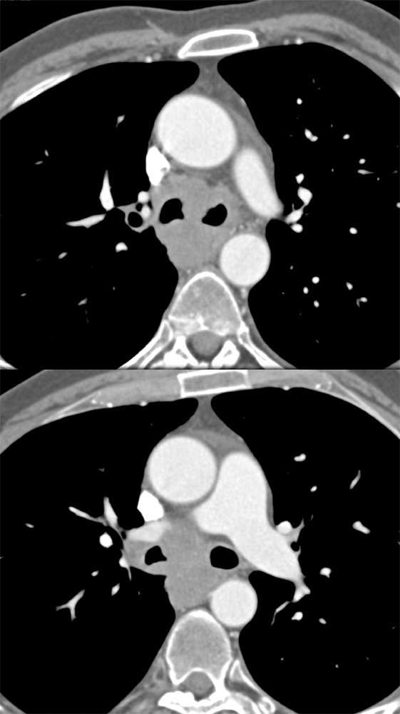 Carcinoid Tumor