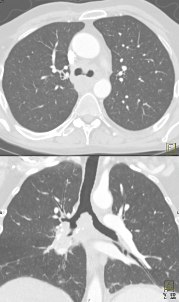 CT of the Trachea