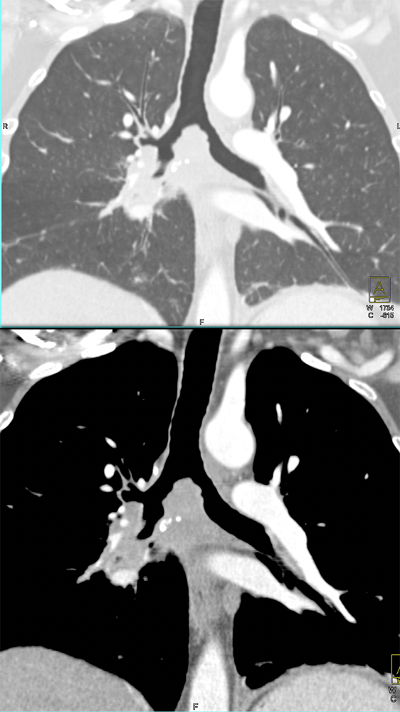 CT of the Trachea