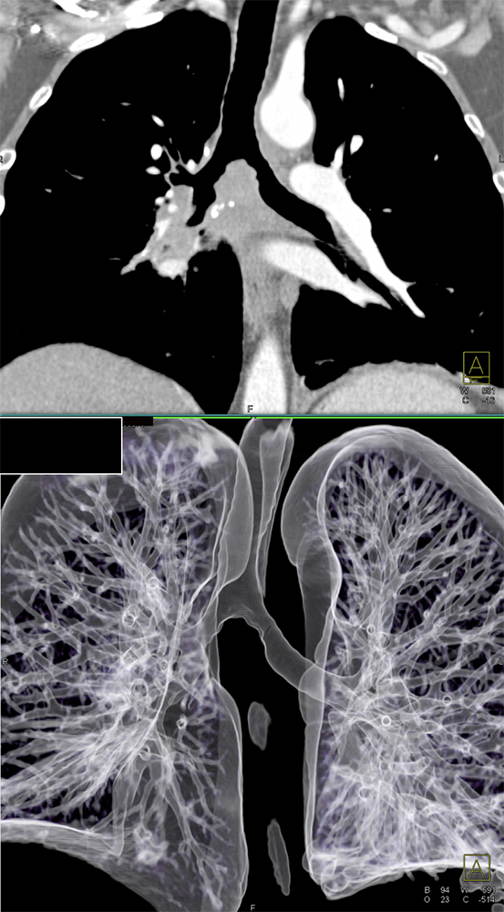 CT of the Trachea