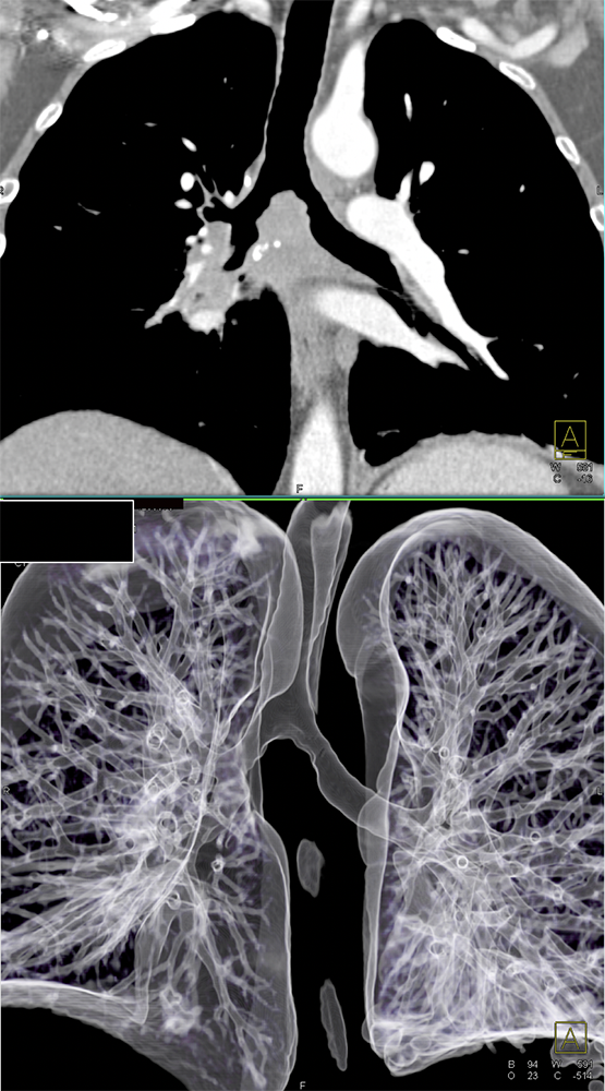 CT of the Trachea
