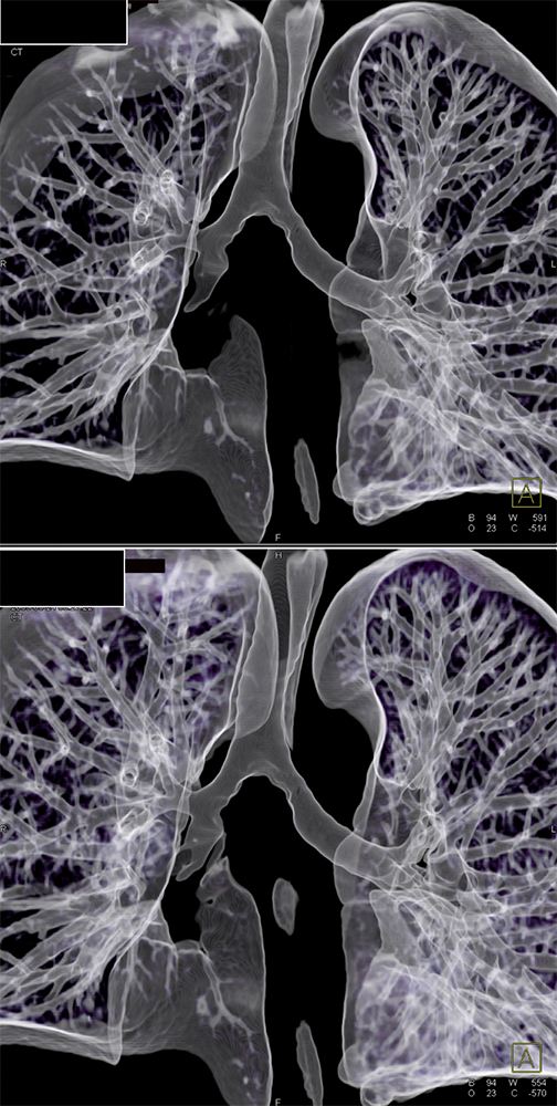 CT of the Trachea