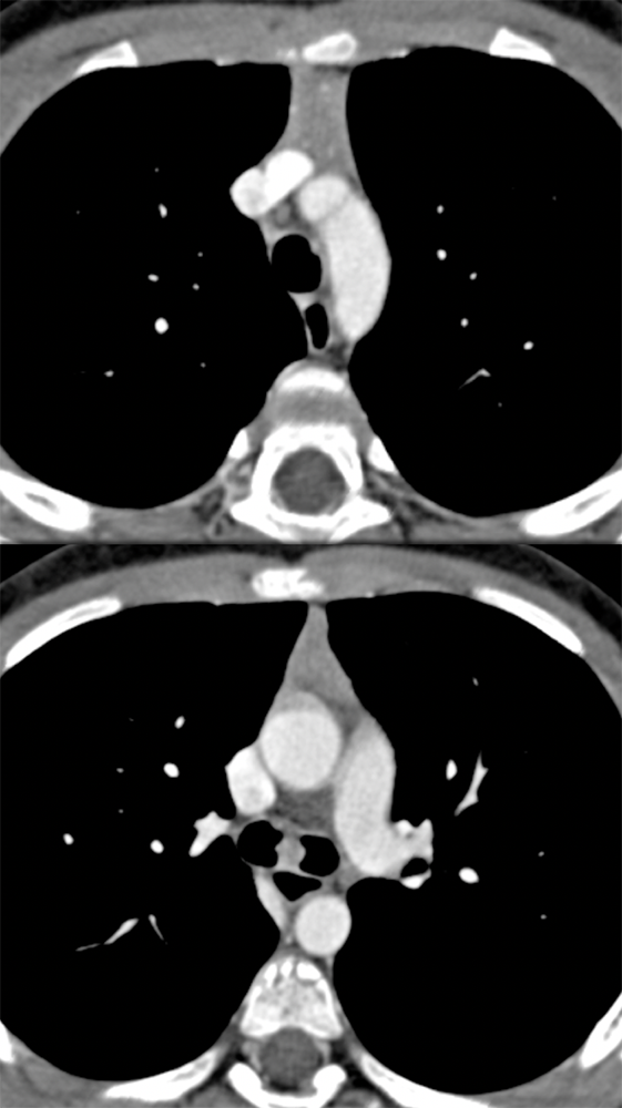 Cough and Hemoptysis