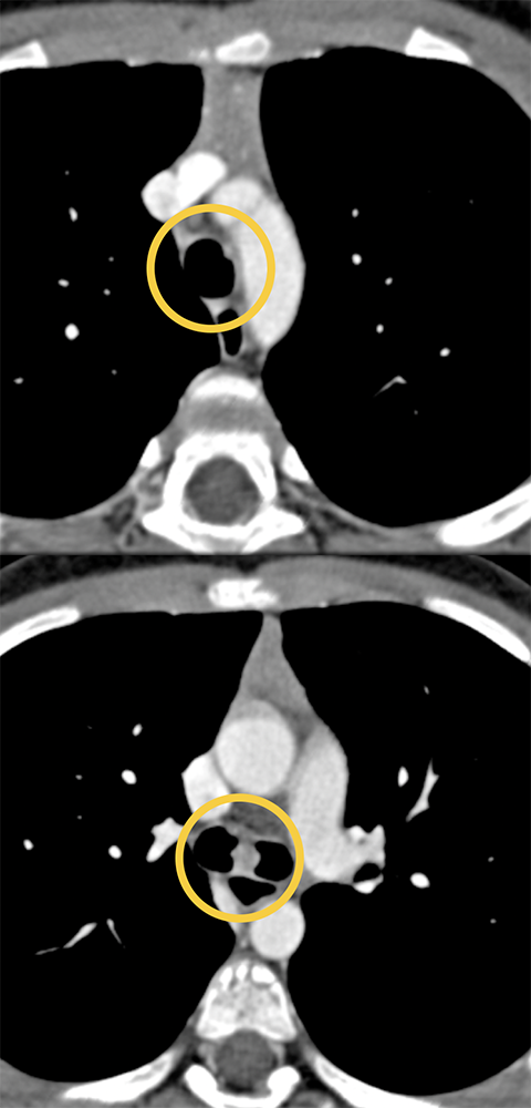 CT of the Trachea