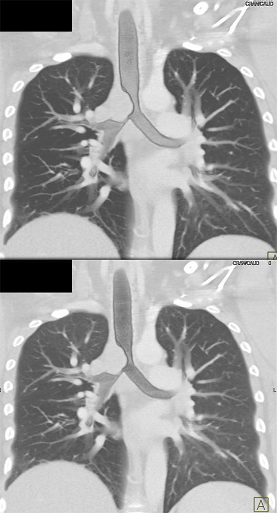 CT of the Trachea