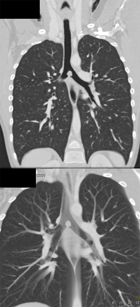 CT of the Trachea