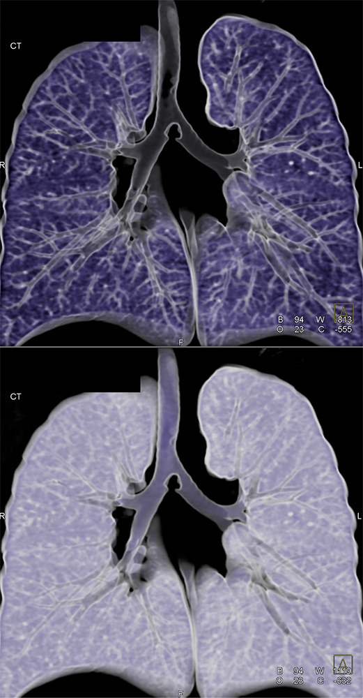 CT of the Trachea