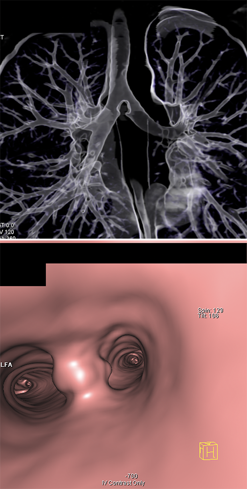 CT of the Trachea