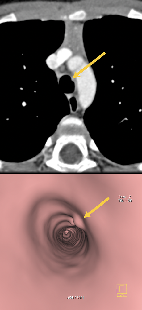 CT of the Trachea