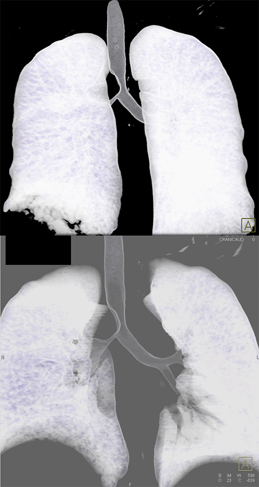 CT of the Trachea