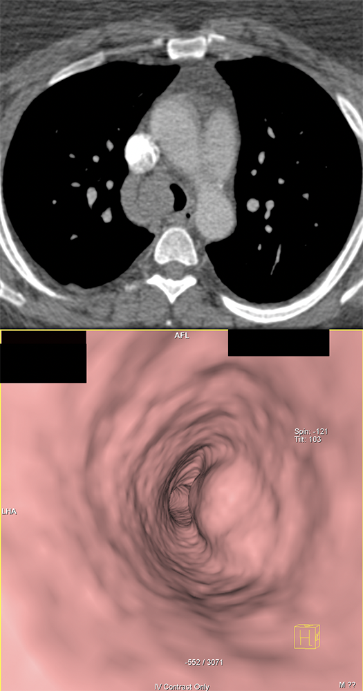 CT of the Trachea