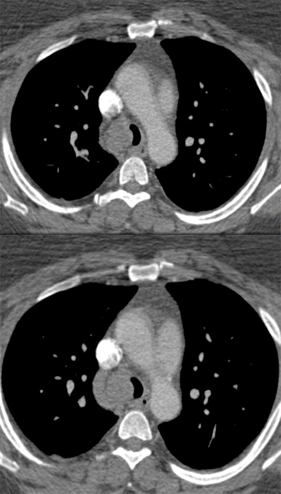 Tracheal Tumor: Adenoid Cystic Carcinoma