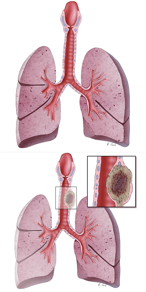Tracheal Tumor