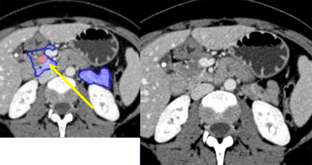 Example of FALSE POSITIVE case of deep network prediction of pancreatic cancer (PDAC)