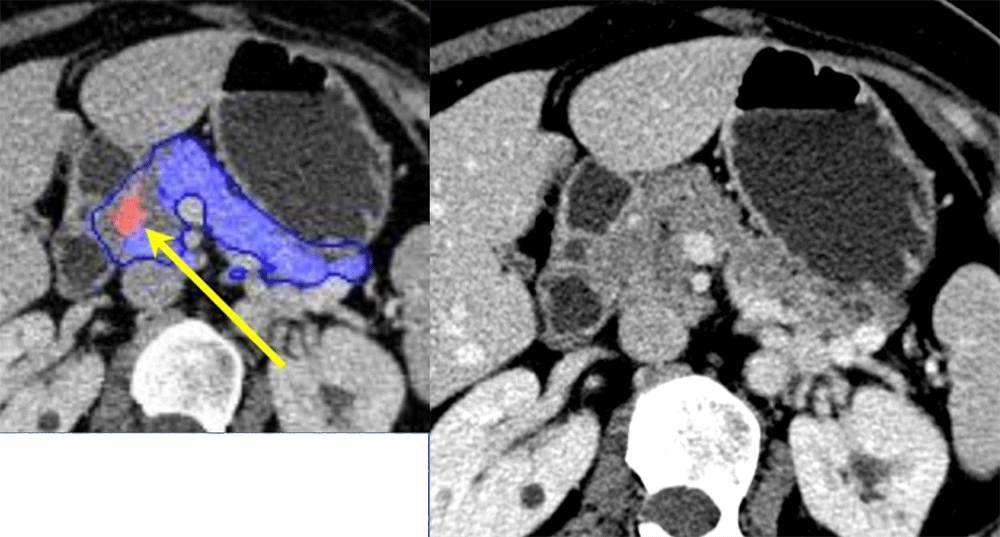 Example of FALSE POSITIVE case of deep network prediction of pancreatic cancer (PDAC)